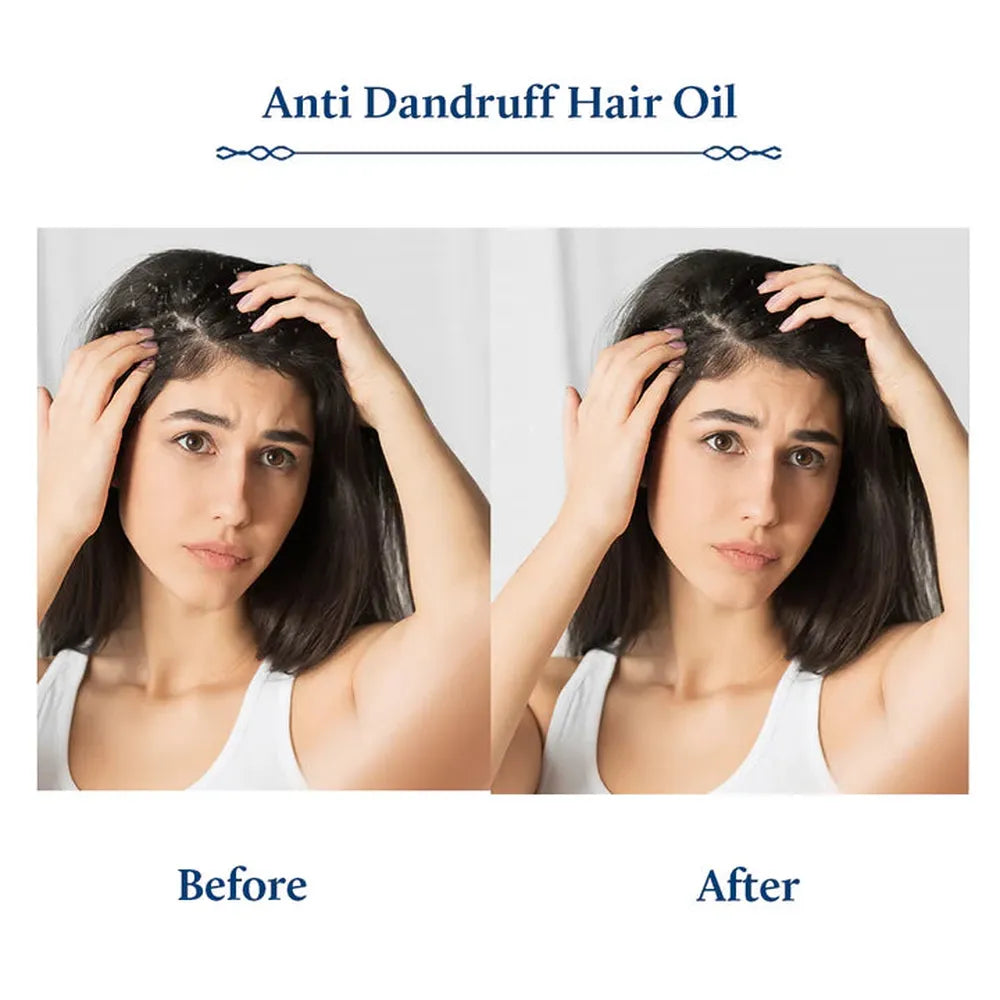 Blue Nectar Briganantadi Tea Tree Anti Dandruff Oil for Hair | Clean & Healthy Scalp - 100ml